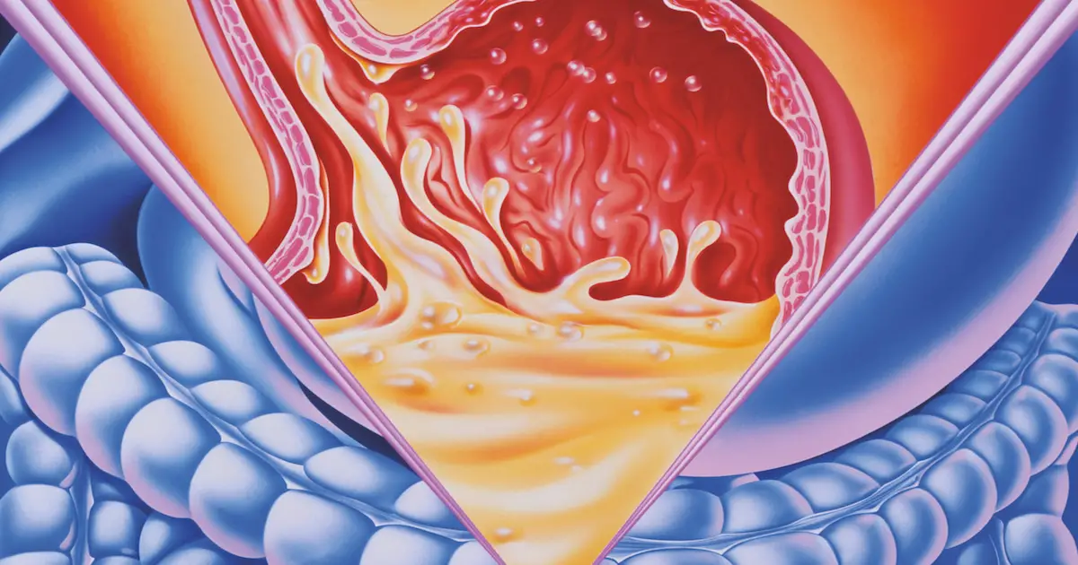 The Low Down on Stomach Acid & How to Master Digestion