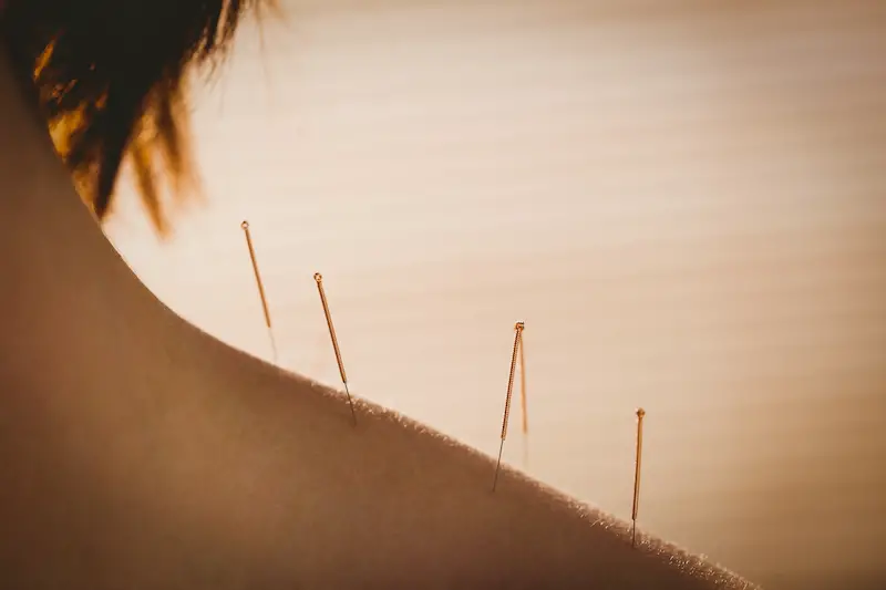 Benefits of Acupuncture