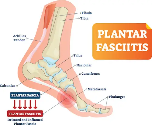 Plantar fasciitis vector illustration. Labeled human feet disorder diagram.
